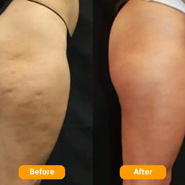 Z3 ZemoKL Cellulite Remover